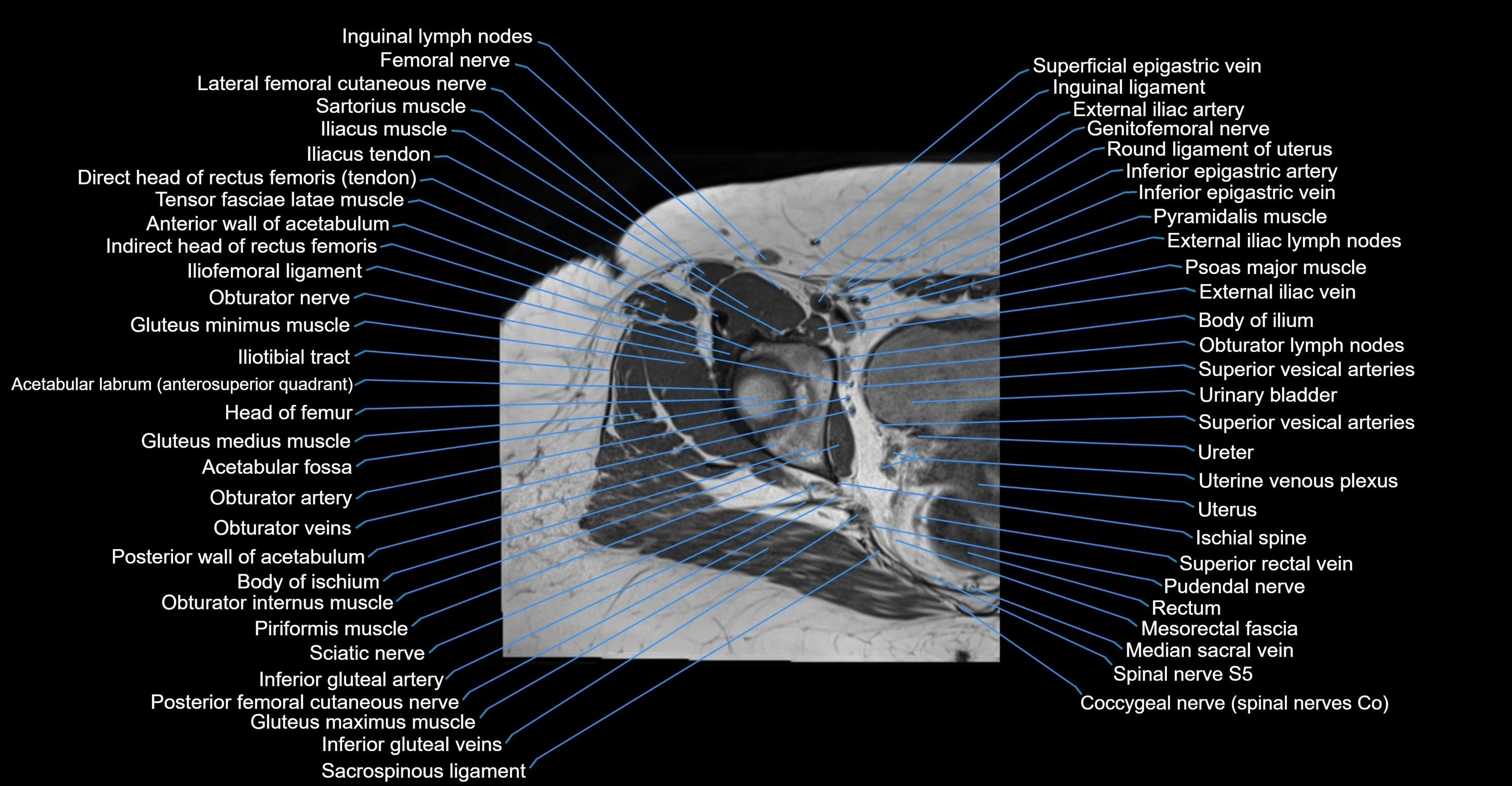 MRI hip axial cross sectional anatomy 3T 3D  radiology  anatomy image-img-00001-00029.webp
